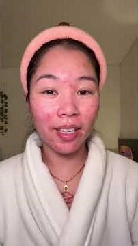 giving panoxyl pimple patches a second chance 🥹 #acne #pimplepatch #skincare