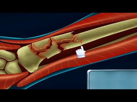 Hand Fracture Surgery | Complete Operation & Recovery Process