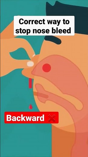 Nosebleeds: Lean forward vs Lean Backwards?