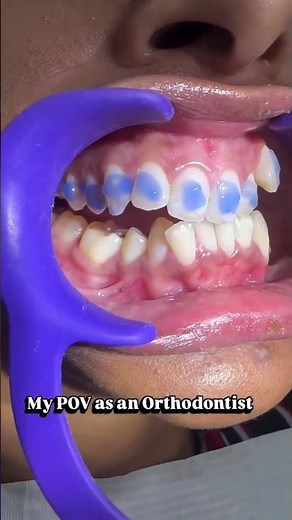 Getting braces?? What to expect during the first appointment.