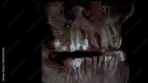 CT scan concept: Video of the x-ray overview of an orthodontic tooth implant. Axial Computed Tomography,