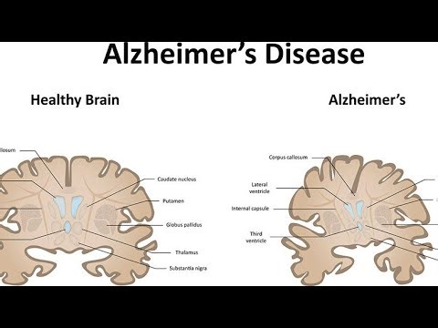 All About Alzheimer’s Disease | Memory Loss & Brain Health Awareness