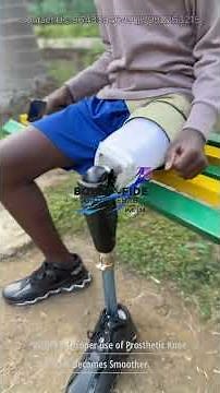 Above Knee Prosthesis | Stages of Prosthetic Training | Walking with Transfemoral Prosthetic Leg