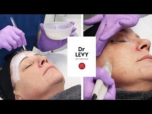 Microdermabrasion with Dr Levy | The Laser and Skin Clinic