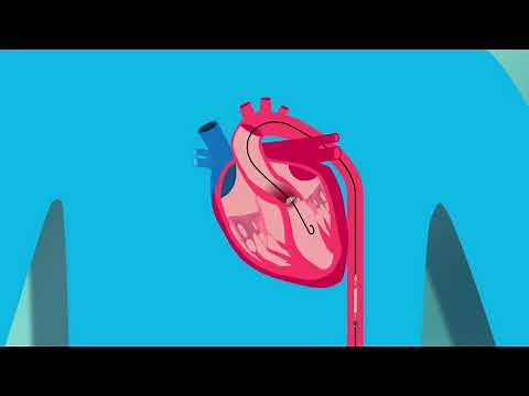 IMPLANTACIÓN DE VÁLVULA AÓRTICA TRANSCATETER (TAVI)