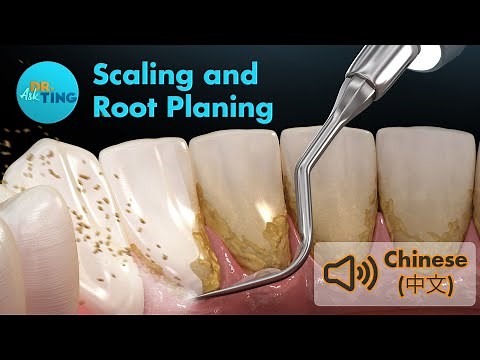洗牙和深层清洁牙齿 | Scaling and Root Planing (SRP) | Ask Dr. Ting