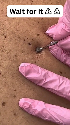 Pimple Popping on Instagram: "Amazing pimple squirts 😲 🔥"