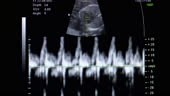 Imagen de ultrasonido del latido del corazón del bebé con el...