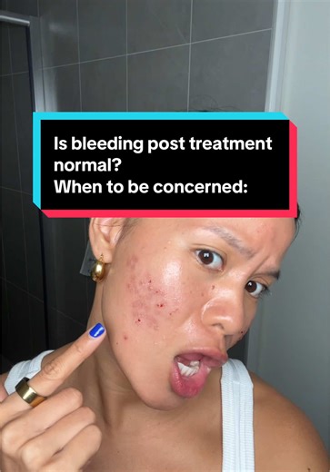 Understanding Bleeding After TCA and CO2 Laser Treatments