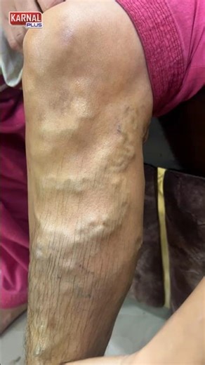 💥 नसों की ब्लॉकेज और गांठ का खात्मा #shortsfeed #vericoseveintreatment