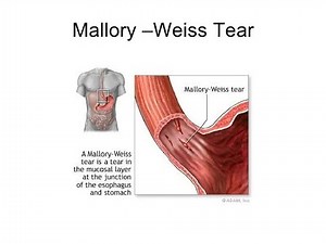 Mallory Weiss Tears (Syndrome) ; Definition, causes, Symptoms, Diagnosis, Treatment, complications