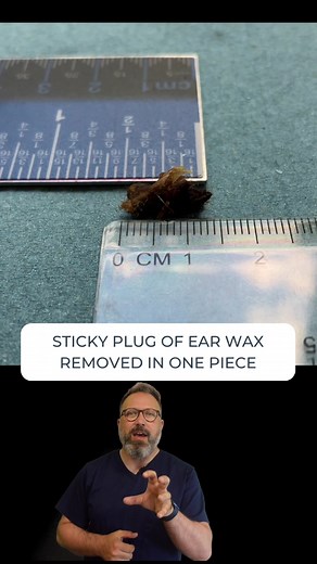Sticky Earwax Plug Removal in One Piece