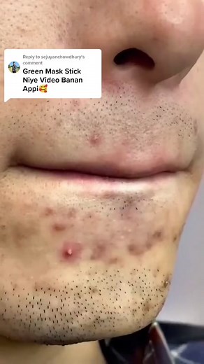 Green Mask Stick for Clear Skin