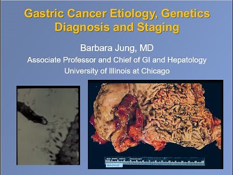 Gastric Cancer Etiology, Genetics, Diagnosis and Staging