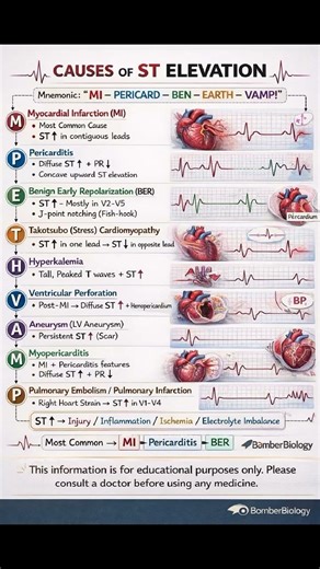 the major causes of ST elevation on an ECG. It is designed for quick recall and deeper understanding