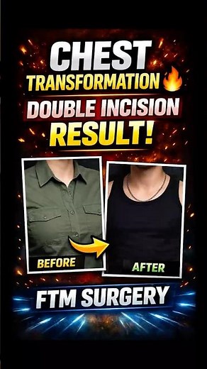 How Double Incision Creates the Most Natural Chest #ftm #topsurgery #beforeafter