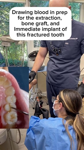 🩸 Tooth Extraction, PRF & Implant Preparation in Walnut Creek, CA #implants #prf #extraction