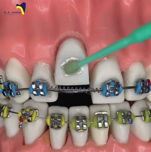 How to Rebond a Broken Orthodontic Bracket: The Correct Bonding Technique #orthodontic #bracket