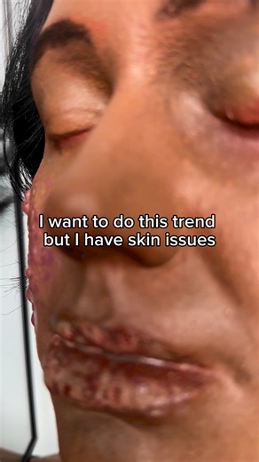 How do you tackle painful boils and cysts on daily basis? Share your tips and tricks! #skinissues #healing #mymagichealer #wellness #glowup #story #storytime #viral #fyp #skincare | Mymagichealer