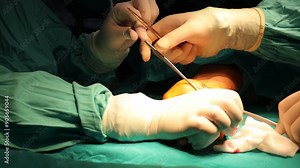 Surgeon With Assistance Performing Delicate Hand Surgery In An Operating Room. Medical, Healthcare, And Surgical Precision Concepts Stock Video
