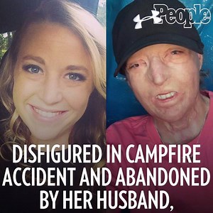 1M views · 13K reactions | This mom, who was disfigured after a...