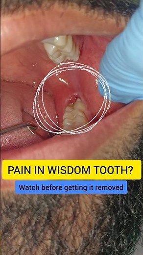 Pain in Wisdom Tooth? Watch this before getting it removed: Dr. Srishti Bhatia #pain #teeth #laser