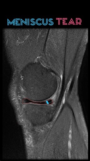 496 reactions · 70 shares | MRI Knee Insight 例嗢 Here we can clearly...