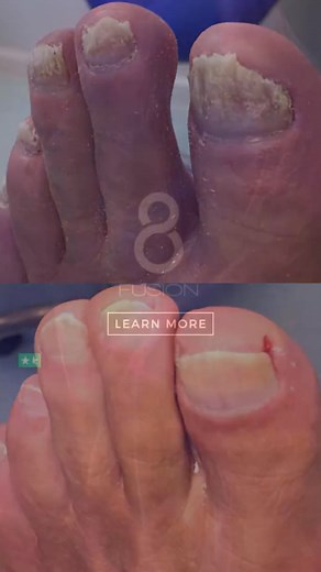 From acne to ageing, this one device treats it all 🧬 Deliver visible results clients trust and profits your business can count on with Fusion 8! Explore the device experts can't stop talking about, with prices starting from $13,000. | Plasma Pen