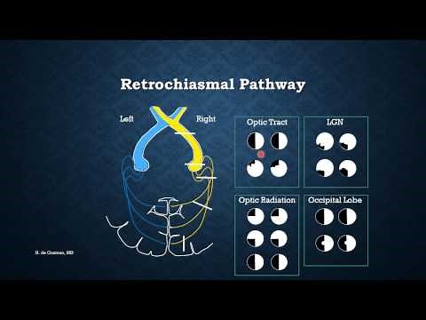 Visual Field: The Basics by Dr. Hannah de Guzman