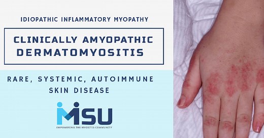 Clinically Amyopathic Dermatomyositis (CADM) - Myositis Support and Understanding