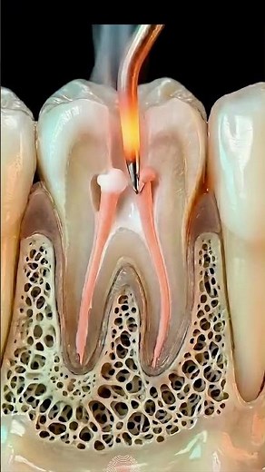 Root Canal Treatment Explained | Step by Step Anim