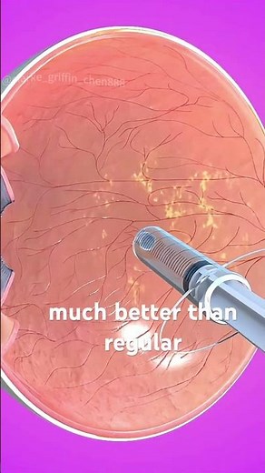 Intraocular Drug Injection To Treat Eye Conditions (3D Animation)#intraoculardruginjection