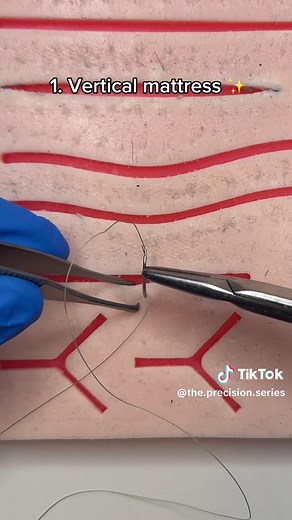 Vertical vs Horizontal Mattress Techniques in Surgery