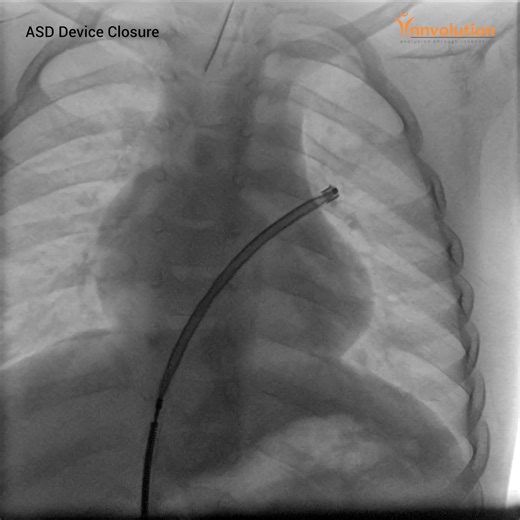 Innvolution on Instagram: "Atrial Septal Defect - A 3-year-old child was diagnosed with an Ostium secundum Atrial Septal Defect. The ASD device closure procedure was successfully performed using a 16 mm Amplatzer device in our Premier Elite Cathlab. Post-device deployment, an echocardiogram revealed the optimal positioning of the device with no residual shunting, and the patient remained in stable hemodynamic condition. Our Premier Elite Cathlab, equipped with cutting-edge technology and staffed