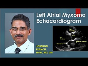 Left Atrial Myxoma Echocardiogram