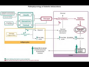 Diabetic Ketoacidosis for the USMLE Step 1