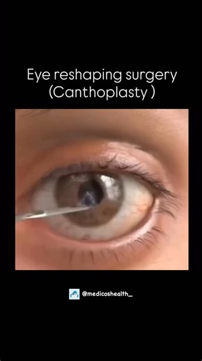 Medical & Health ⚕️ on Instagram: "Canthoplasty is a surgical procedure that reshapes the outer corner of the eye to create a more lifted, almond-shaped appearance. It involves cutting and tightening the lateral canthal tendon. This surgery is often done for cosmetic reasons or to correct sagging eyelids, improving both appearance and eye function. . . Dm for credit or removal 👏🏻 . . . #viral #explore #medical #reel #education #doctor #medicalstudent #student #biology #study #science #mbbsstud