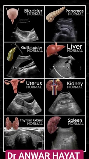 Normal Ultrasound Images of Common Human Organs#UltrasoundImages #NormalAnatomy #Ultrasound #shorts