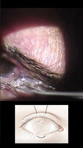 Tarsorrhaphy; When we Suture Eyelids together #eyedisease #science