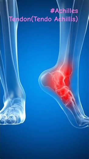 Achilles Tendon Pain Relief | Heel Pain Treatment Fast 🔥 #Shorts