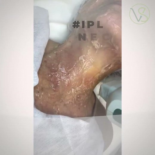 IPL Photofacial treatment of the neck area. Anti-aging.