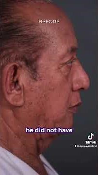 Deep Plane Face & Neck Lift - One Week Post-Op | Dr. Paul Nassif