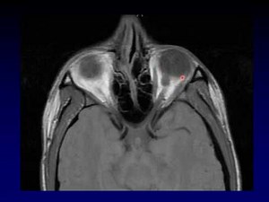 Imaging of the Eye and Orbit, Part 2