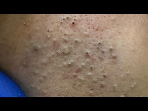 Deep Cleansing Techniques — Amazing Acne Removal Facial Care Routine