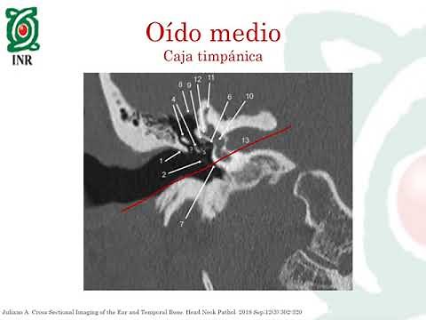 Anatomía radiológica de oído