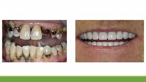 How Long Is The Procedure For An All-On-Four? | The CDG of Houston