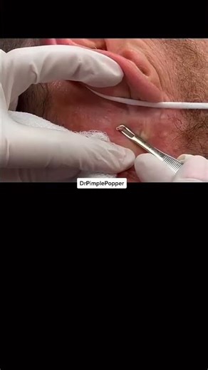 Dropping Blackheads #shorts #blackheads #drpimplepopper #pimple #pimplepopping