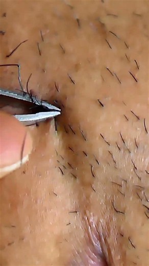 The Sting of Every Beard Pluck13