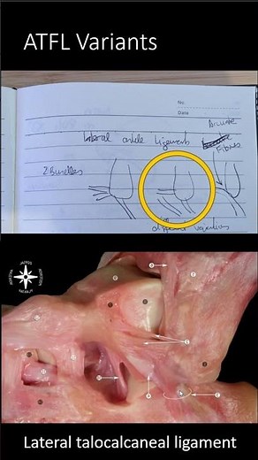 ESSR 2023 Bilbao Highlight 1 - Lateral Ankle Ligament Variants