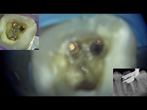 Management of Strip perforation in a mandibular molar